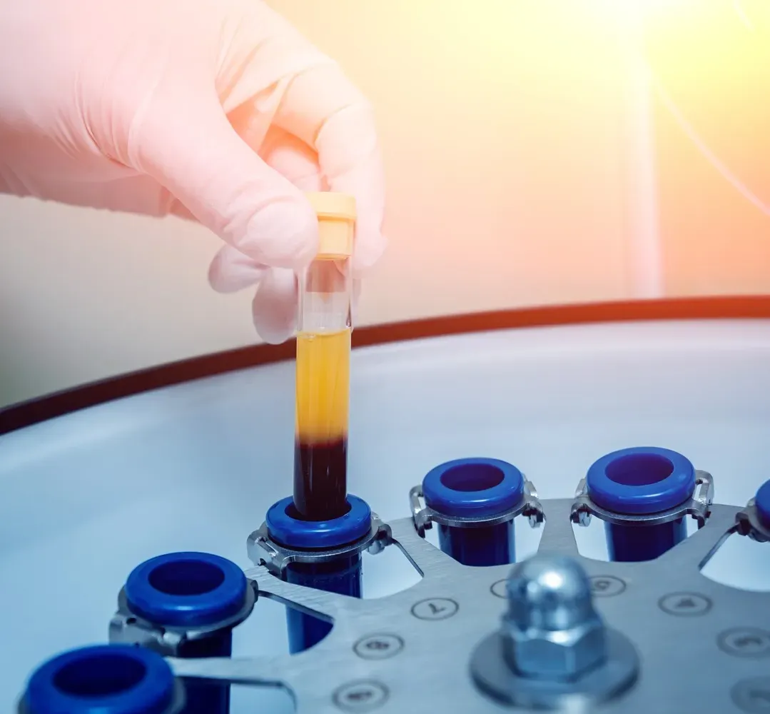 Platelet-Rich Plasma (PRP)