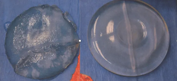 Defective breast implants