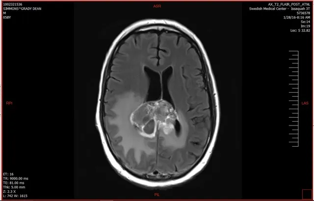 Brain scan showing a tumor from Glioblastoma