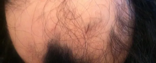 Balding patient diagnosed with alopecia — alternative medical techniques are successful for treating alopecia
